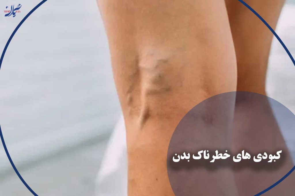 مهمترین کبودی های خطرناک بدن