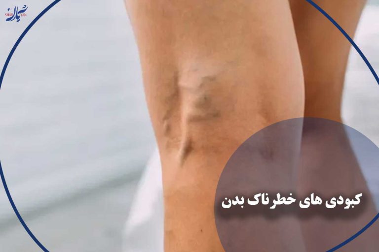 مهمترین کبودی های خطرناک بدن