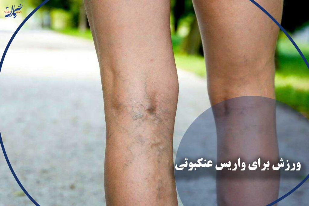 حرکات ورزشی برای واریس عنکبوتی