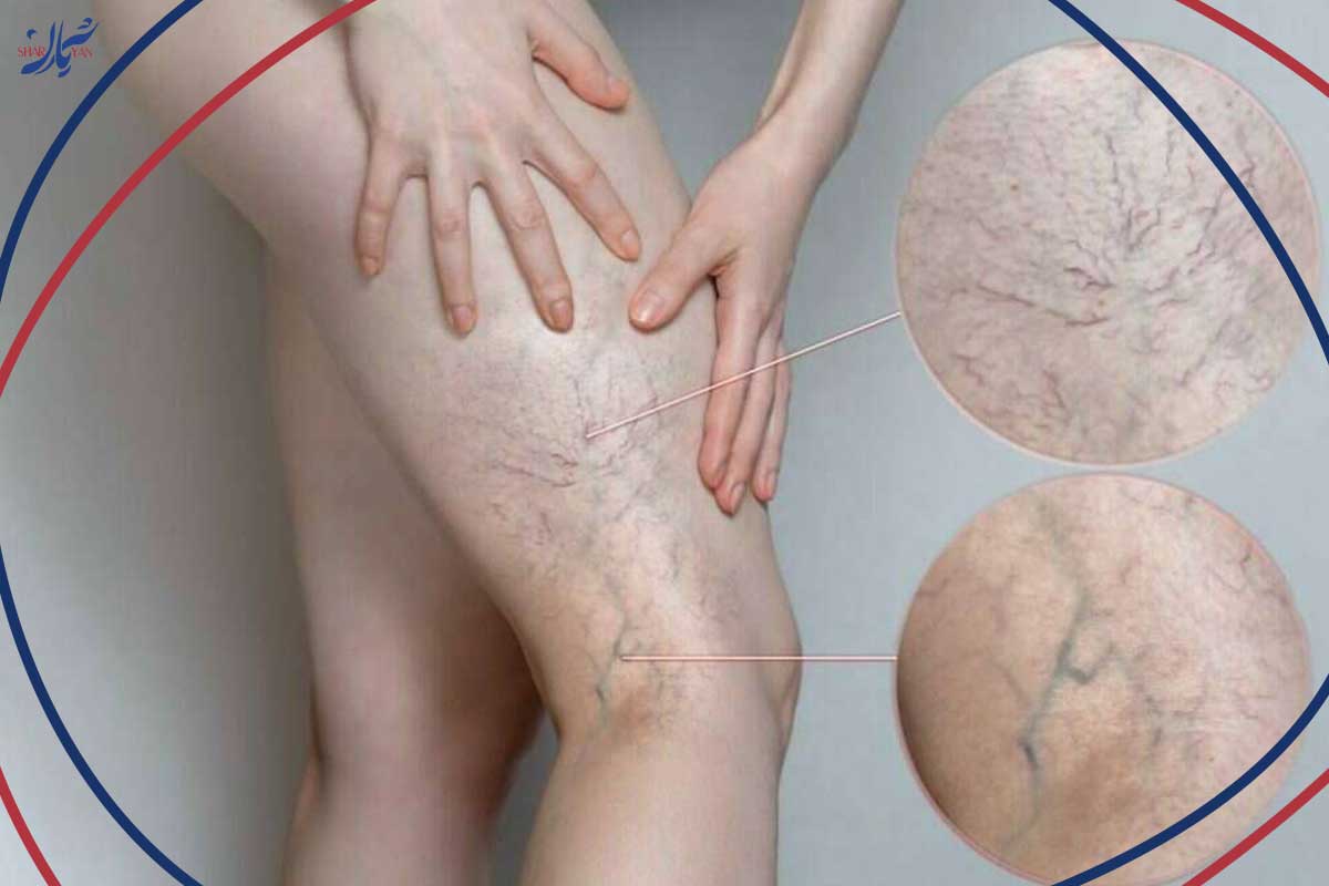 چرا حرکات ورزشی برای واریس عنکبوتی معجزه می‌کند؟