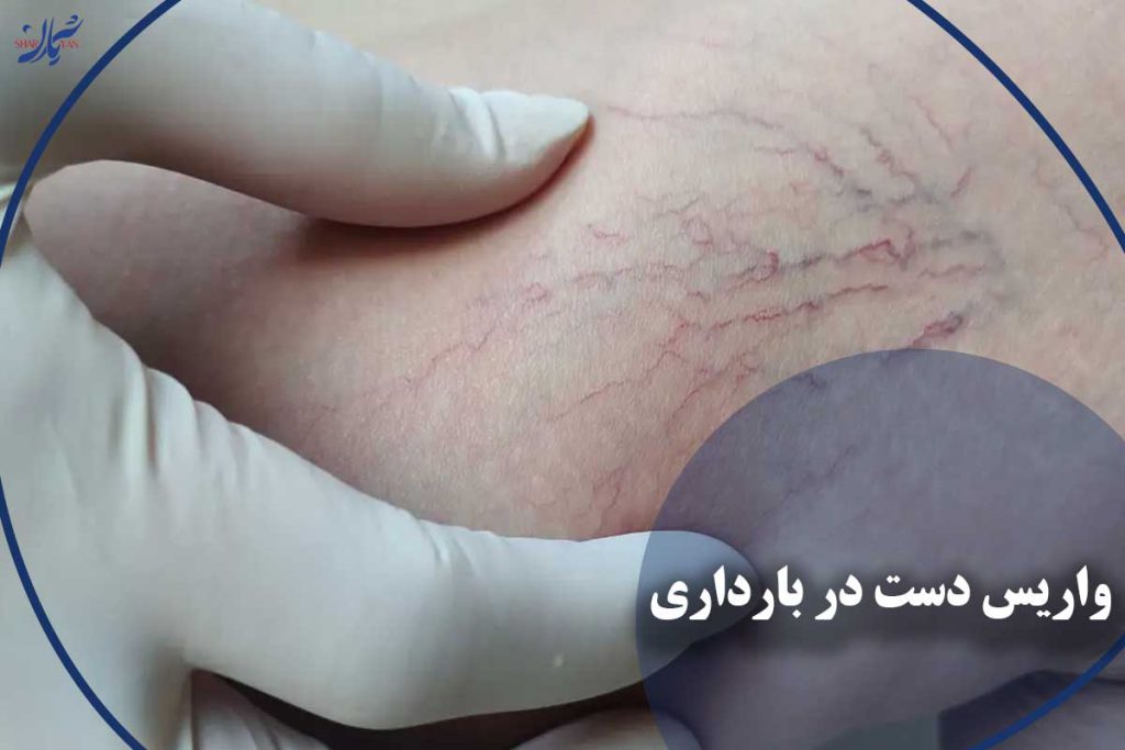 واریس دست در بارداری