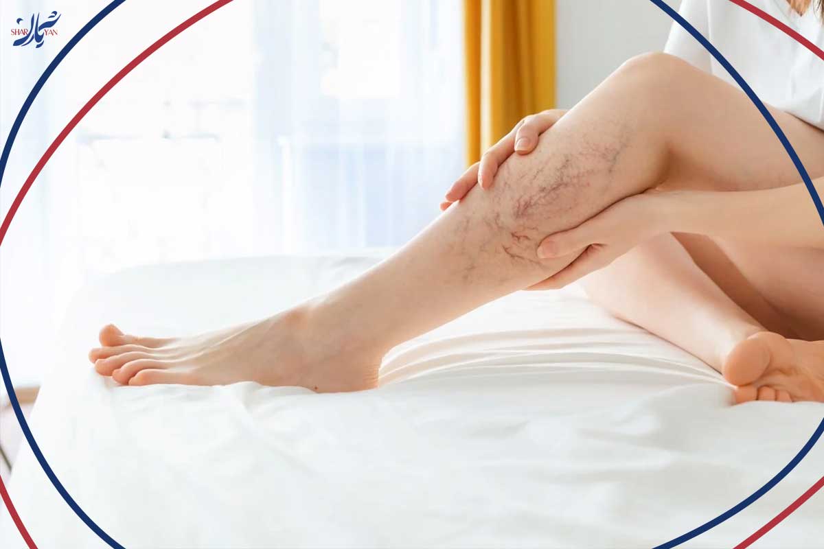روش‌های نوین درمان واریس و رفع کبودی‌های عروقی (بدون نیاز به جراحی سخت)