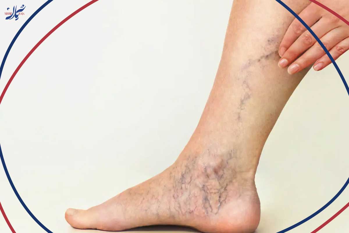 تجربه خانم پیمایش از برجستگی رگ‌های دست در ماه ششم بارداری