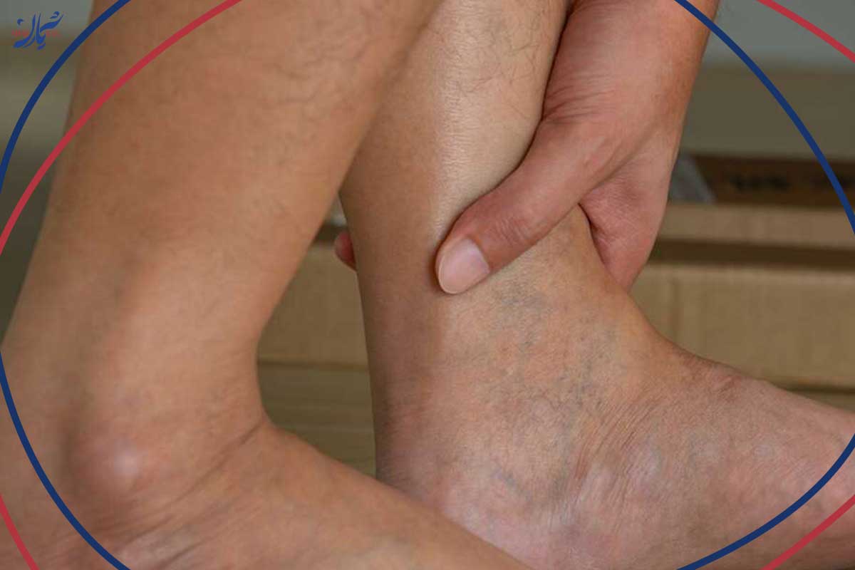 کدام ورزش‌ها برای واریس عنکبوتی خطرناک هستند؟