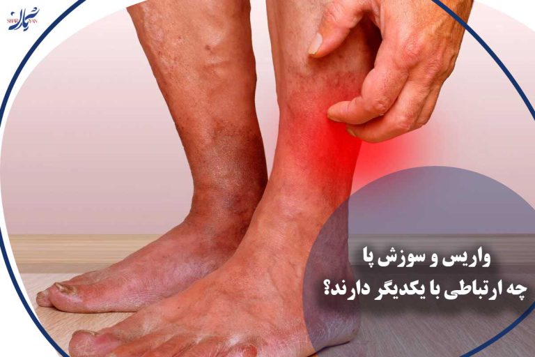 سوزش پا
