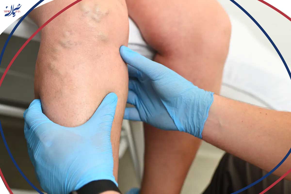 اسکلروتراپی واریس پا چیست و چگونه انجام میشود؟ 3 How to perform sclerotherapy for varicose veins