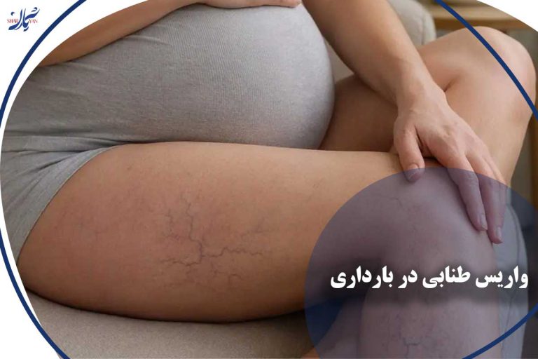 واریس طنابی در بارداری