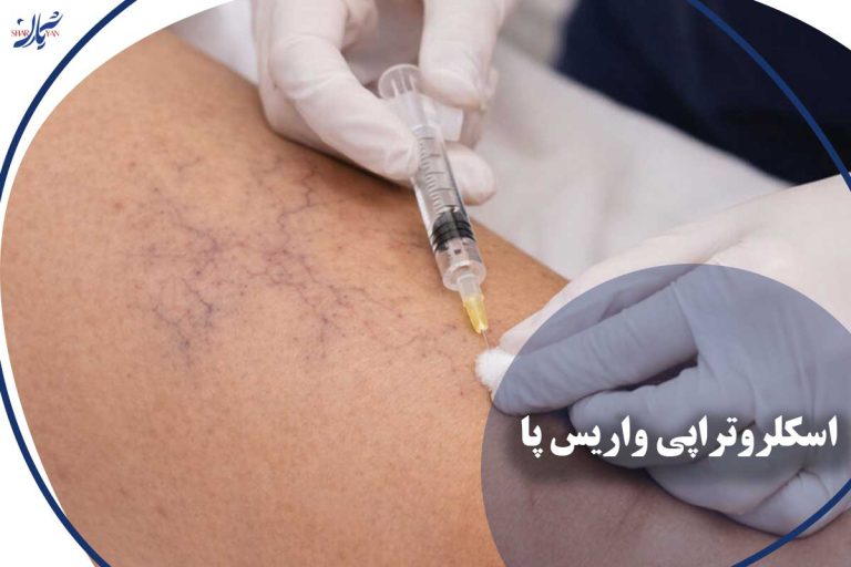 اسکلروتراپی واریس پا