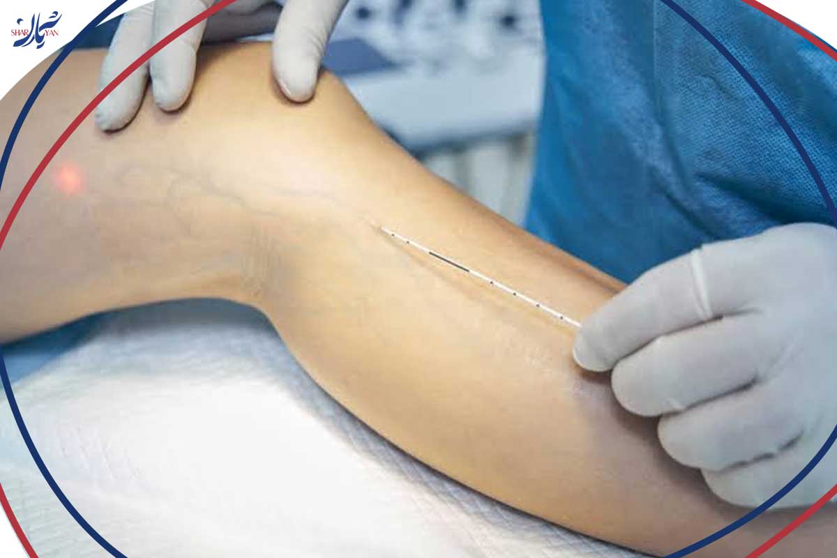 اسکلروتراپی واریس پا چیست و چگونه انجام میشود؟ 2 اسکلروتراپی