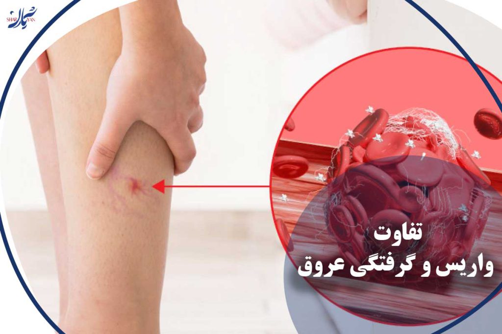 تفاوت واریس و گرفتگی عروق