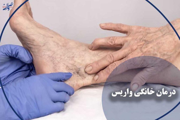 درمان خانگی واریس