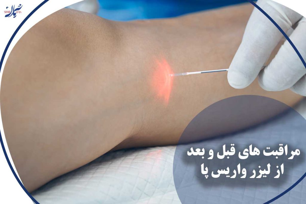 مراقبت های قبل و بعد از لیزر واریس پا