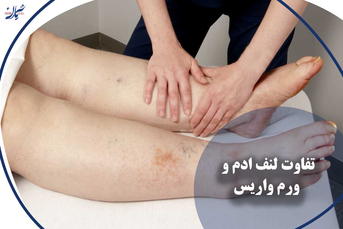 کلینیک شریان|فوق تخصصی ترین کلینیک عروق و واریس 33 تفاوت لنف ادم و ورم واریس
