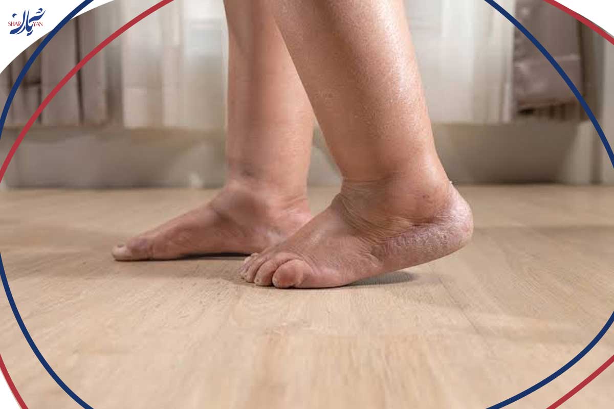لنف ادم چیست؟ 3 تفاوت لنف ادم اولیه و ثانویه