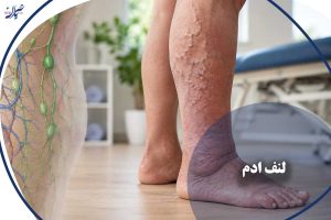 لنف‌ادم
