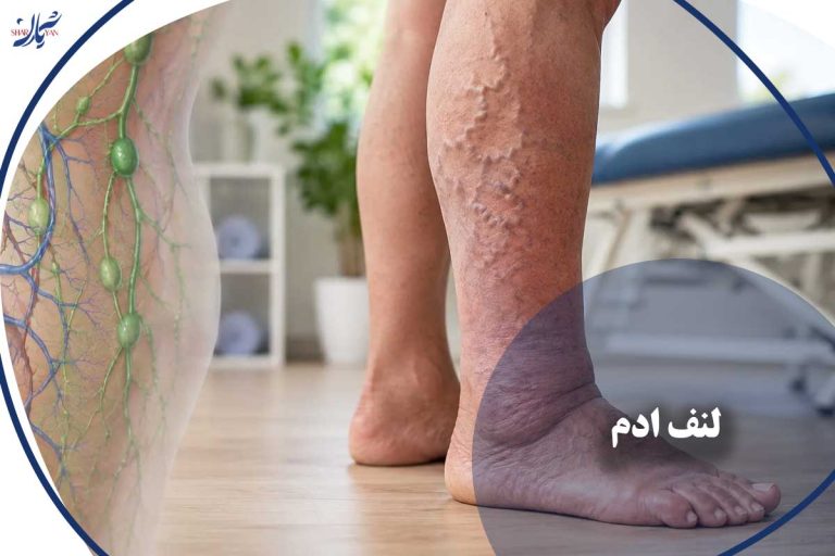 لنف‌ادم