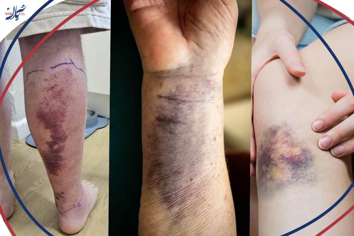 عکس کبودی های خطرناک 