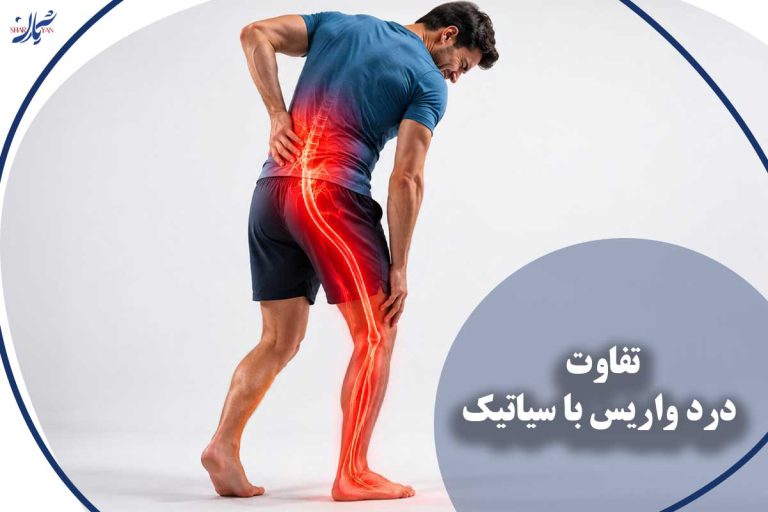 تفاوت درد واریس با سیاتیک