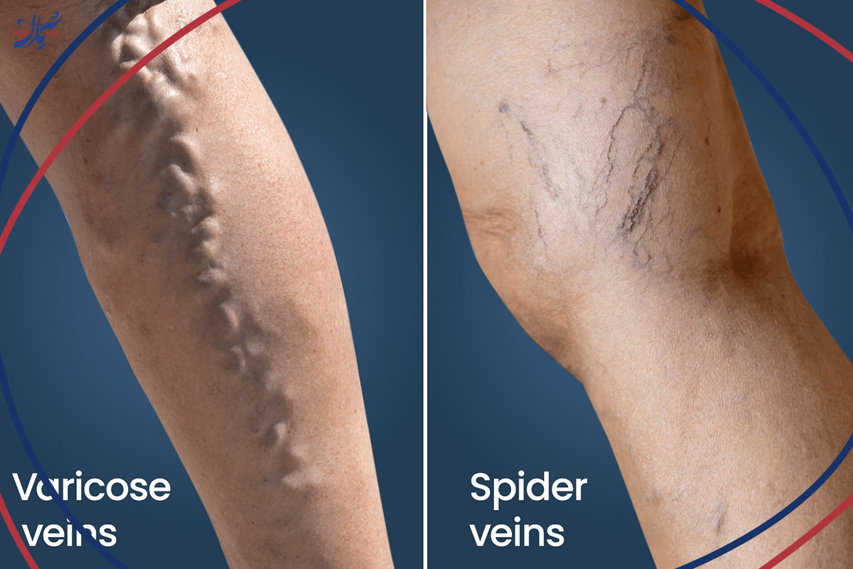 درمان خانگی واریس؛ ۱۰ روش ساده اما موثر برای کنترل علائم 3 Varicose Veins