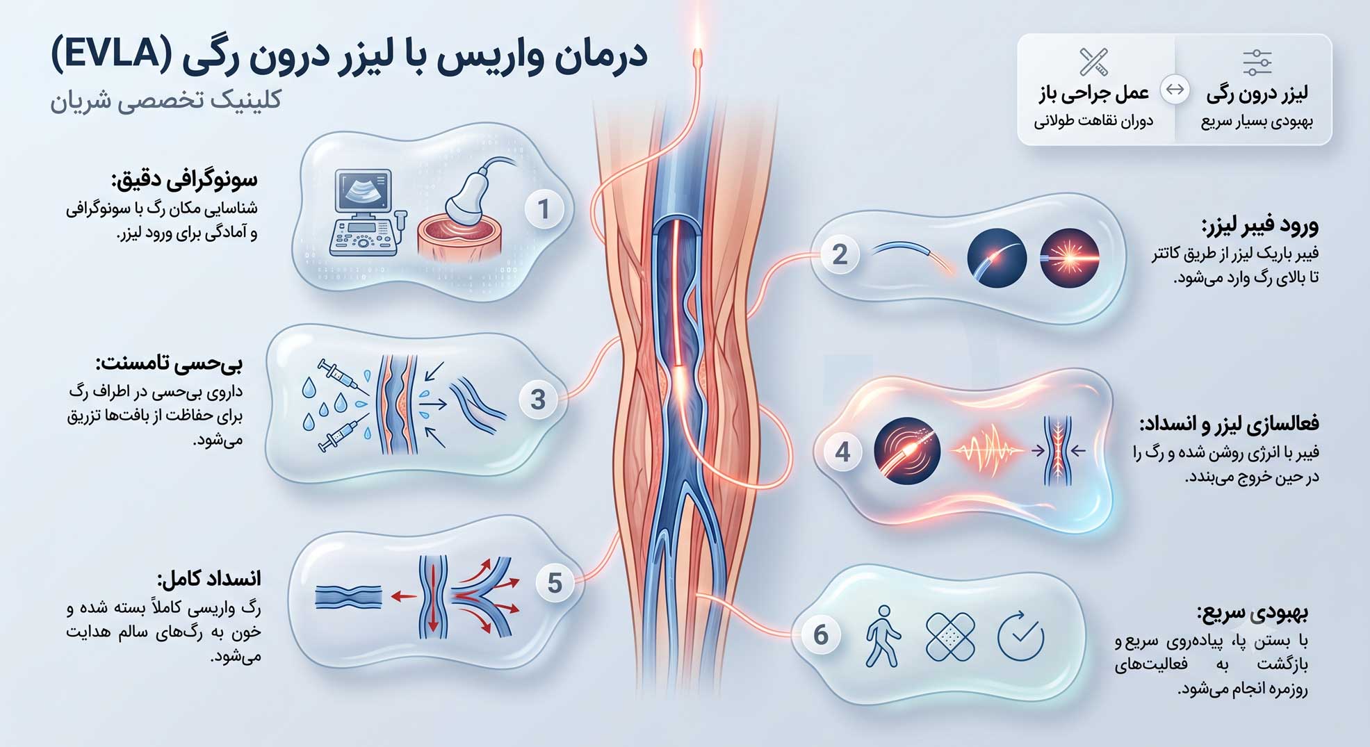 درمان واریس با لیزر درون وریدی EVLA 9 Varicose-vein-treatment-with-endovenous-laser-(EVLA)