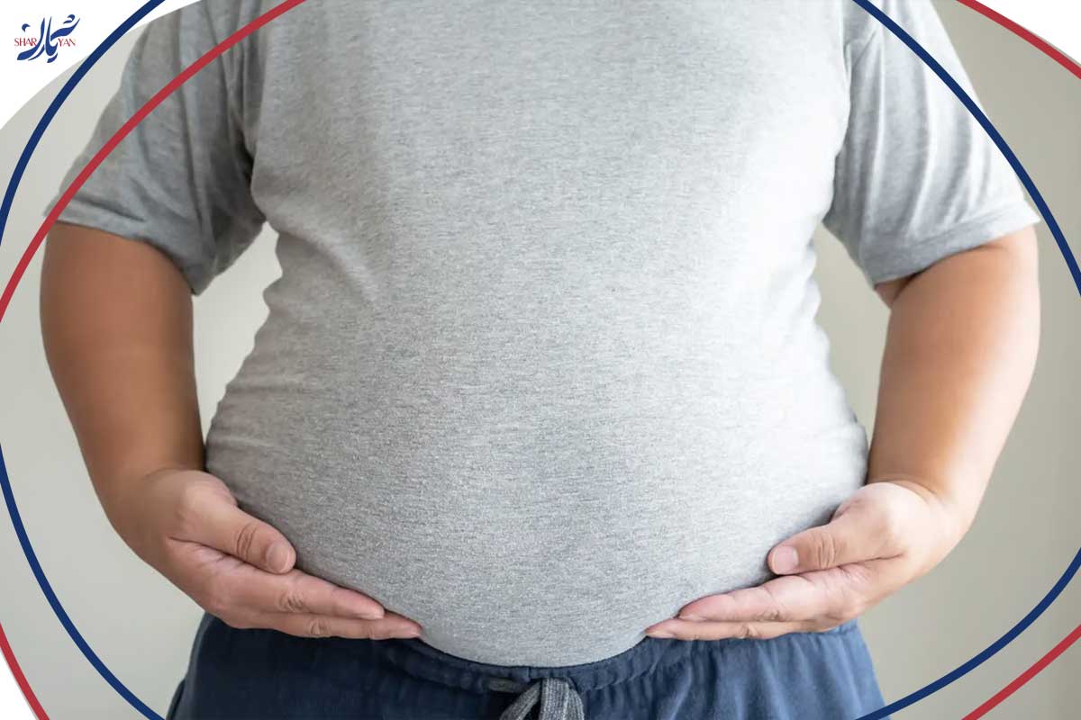 اضافه وزن در بیماران مبتلا به واریس