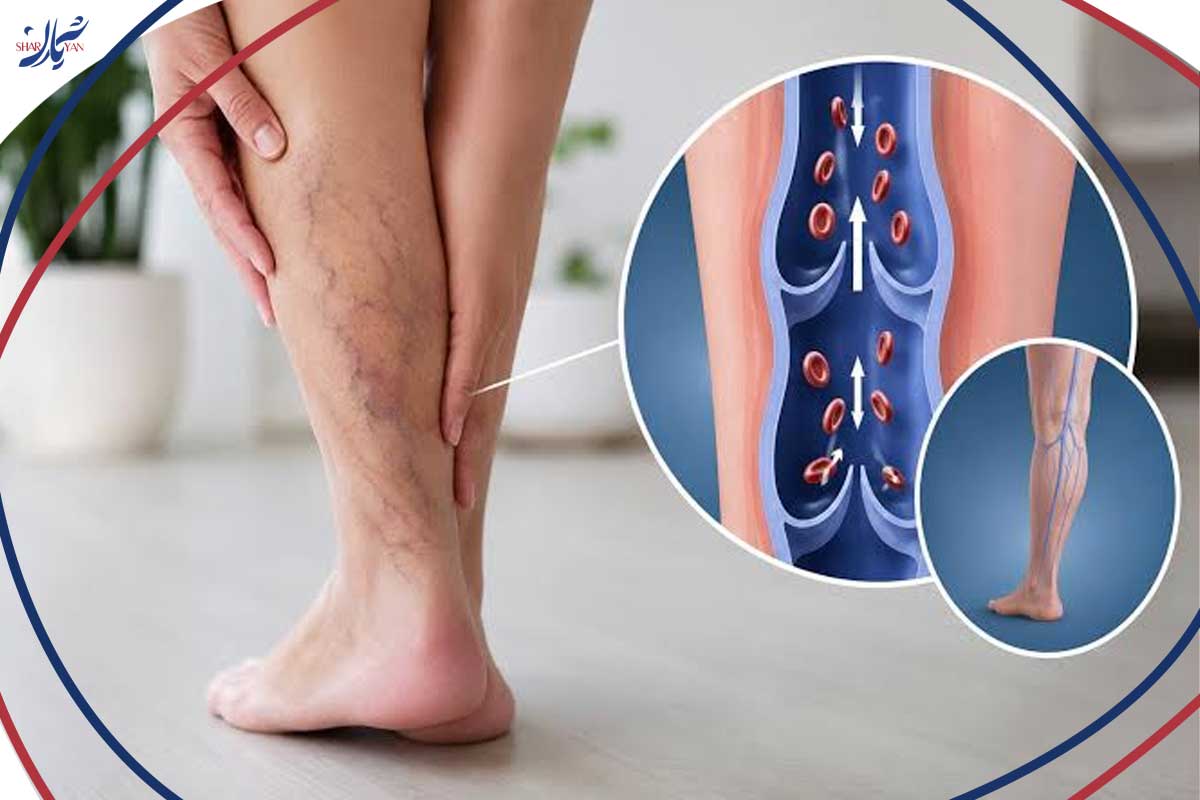 جدول مقایسه شدت علائم واریس در افراد با وزن طبیعی، اضافه وزن و چاقی
