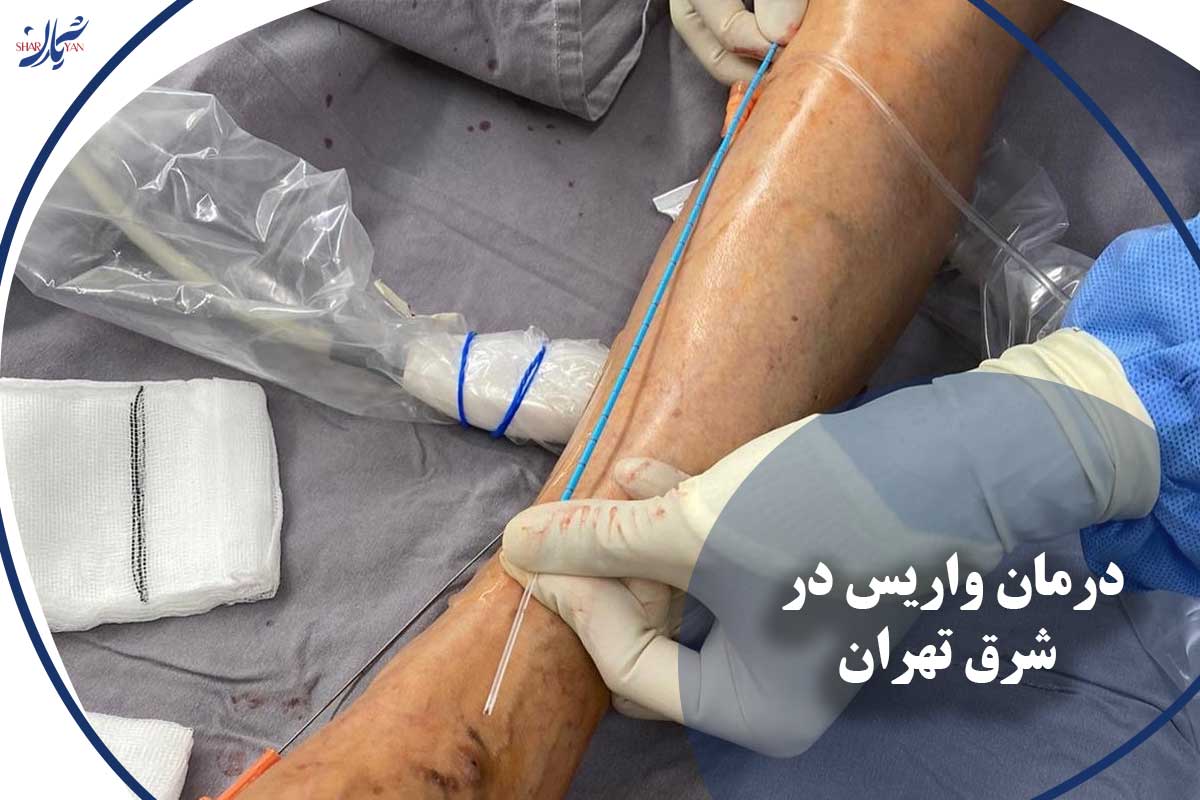 کلینیک شریان|فوق تخصصی ترین کلینیک عروق و واریس 32 درمان واریس در شرق تهران
