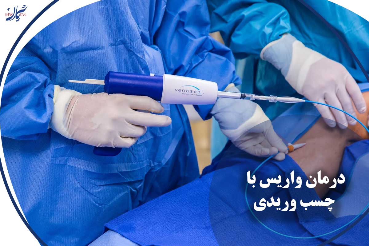 کلینیک شریان|فوق تخصصی ترین کلینیک عروق و واریس 31 درمان واریس با چسب وریدی